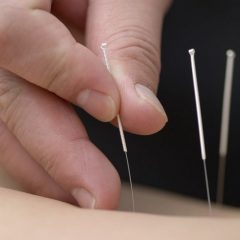 Comment se procurer des aiguilles d'acupuncture