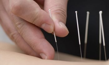 Comment se procurer des aiguilles d'acupuncture